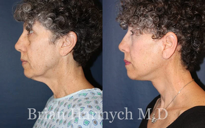 Neck Lift before and after photo