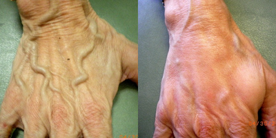 Radiesse before and after photo