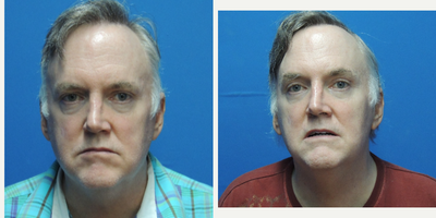 Eyelid Surgery before and after photo