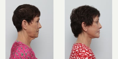 Facelift before and after photo
