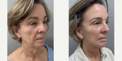 Facelift before and after photo