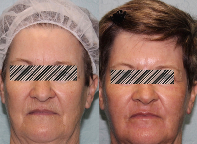 Renuvion for Facial Resurfacing before and after photo