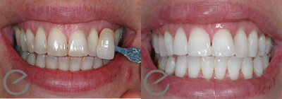 Teeth Whitening before and after photo