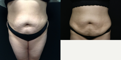 Vanquish before and after photo