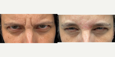 Botox before and after photo