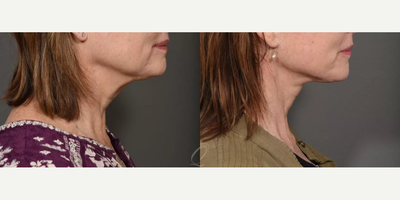 Chin Liposuction before and after photo