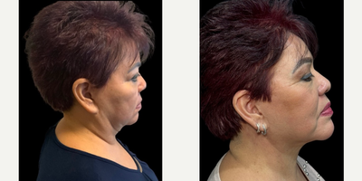 Facelift before and after photo