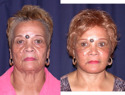 Facelift before and after photo