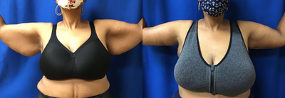 Arm Lift before and after photo