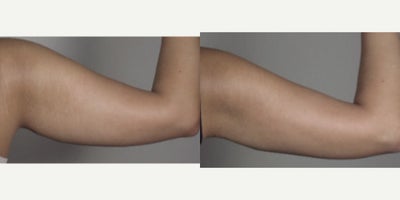 Arm Lift before and after photo