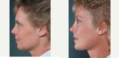 Brow Lift before and after photo