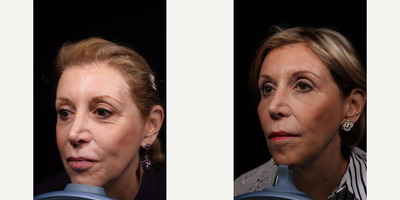 Dermal Fillers before and after photo