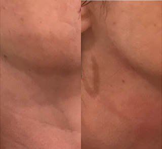 Facial before and after photo