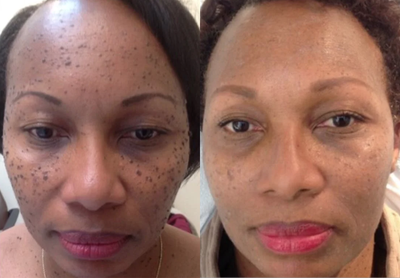 Mole Removal before and after photo