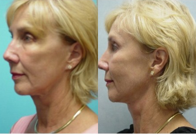 Radiesse before and after photo