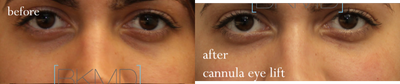 Restylane before and after photo