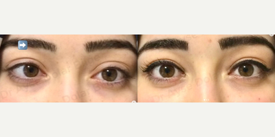 Strabismus Surgery before and after photo