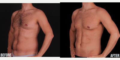 Vaser Liposuction before and after photo