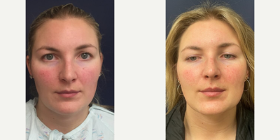 Chin Liposuction before and after photo