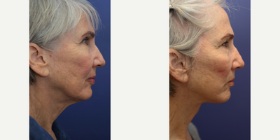 Facelift Revision before and after photo