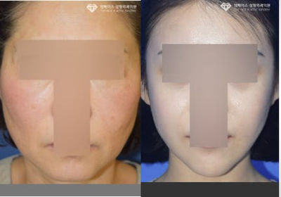 Facelift before and after photo