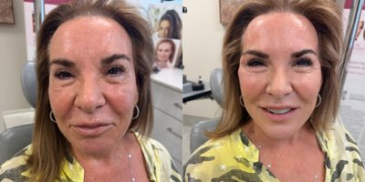Nonsurgical Facelift before and after photo