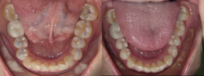 Invisalign before and after photo
