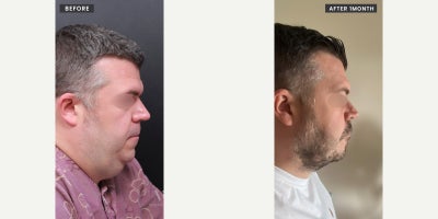 Chin Liposuction before and after photo
