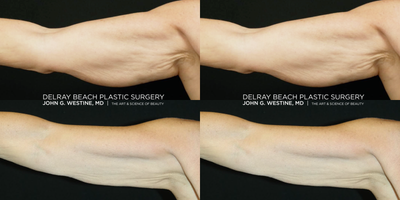 CoolSculpting before and after photo