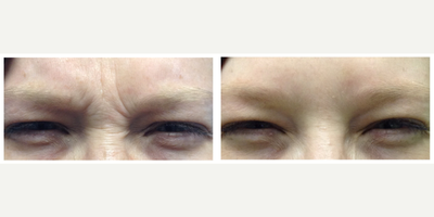 Dysport before and after photo