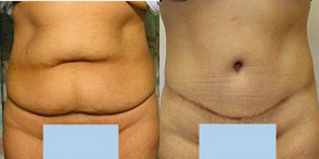 Tummy Tuck before and after photo