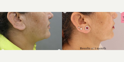 Chin Liposuction before and after photo