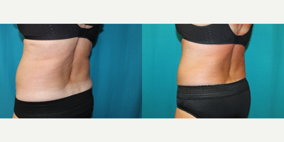 CoolSculpting before and after photo