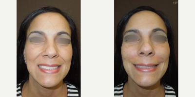 Dermal Fillers before and after photo
