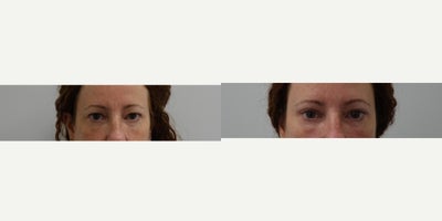 Eyelid Surgery before and after photo