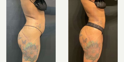 Liposuction before and after photo