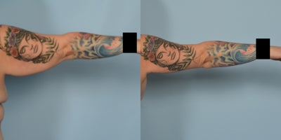 Arm Lift before and after photo