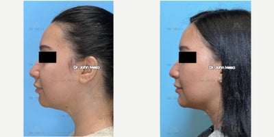 Botox before and after photo