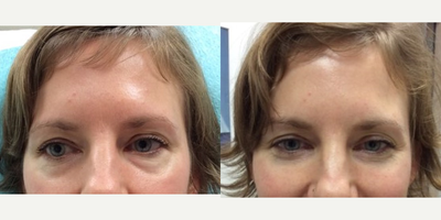 Eyelid Surgery before and after photo