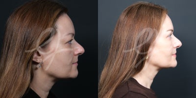 Eyelid Surgery before and after photo