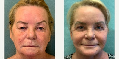 Facelift before and after photo