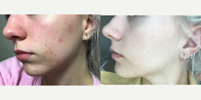 Microdermabrasion before and after photo