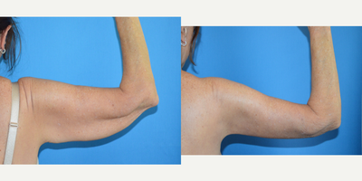 Arm Lift before and after photo