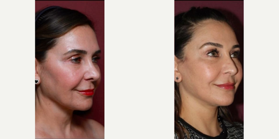 Deep Plane Facelift before and after photo