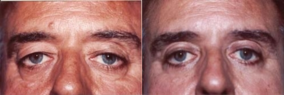Eyelid Surgery before and after photo