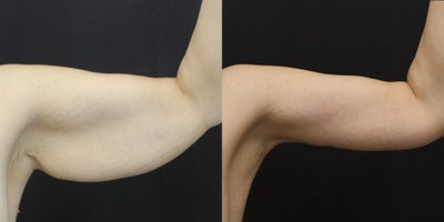 Arm Lift before and after photo