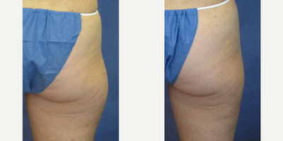 BodyTite before and after photo