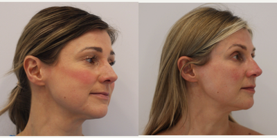 Botox for TMJ before and after photo