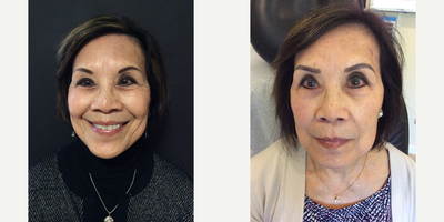 Dysport before and after photo