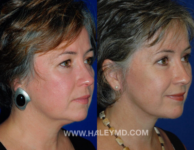 Eyelid Surgery before and after photo